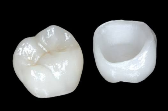 Coroas em Porcelana Pura - Odonto Peres