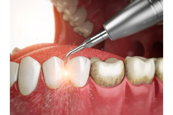 Profilaxia e Raspagem - Odonto Peres Americana SP