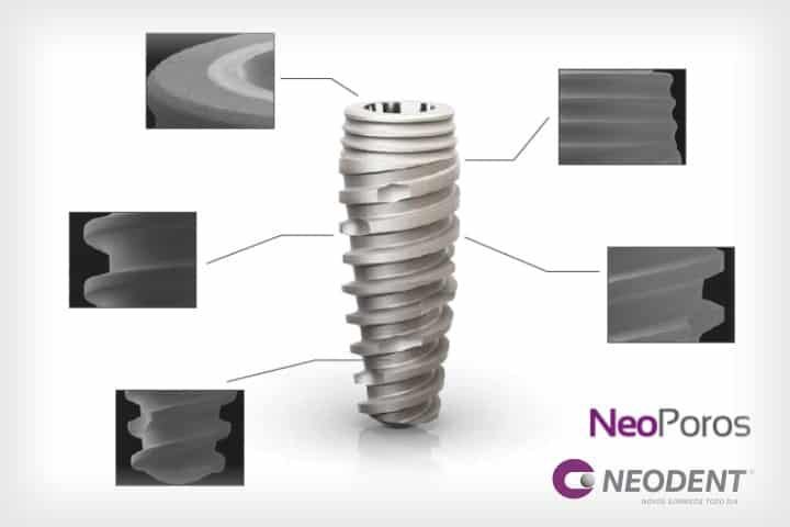 Implantes Dentários Neodent - Odonto Peres